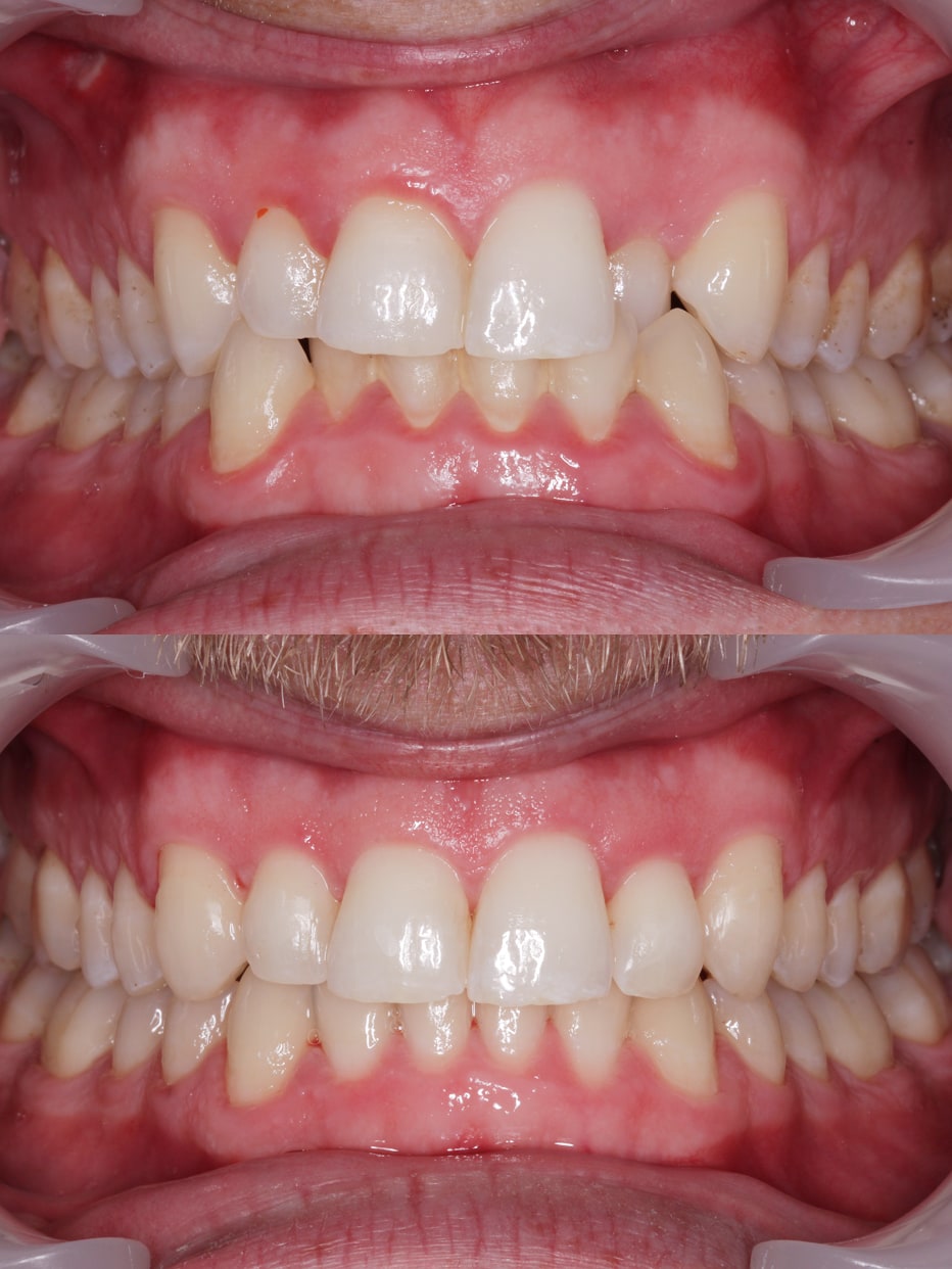 Invisalign results - smile works