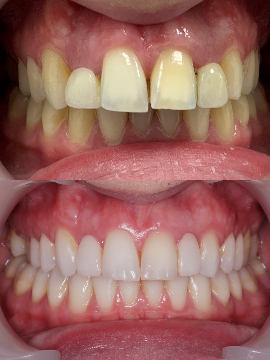 Invisalign results - smile works